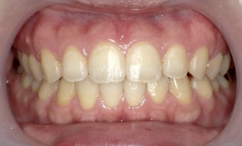 すきっ歯を部分矯正で治した症例