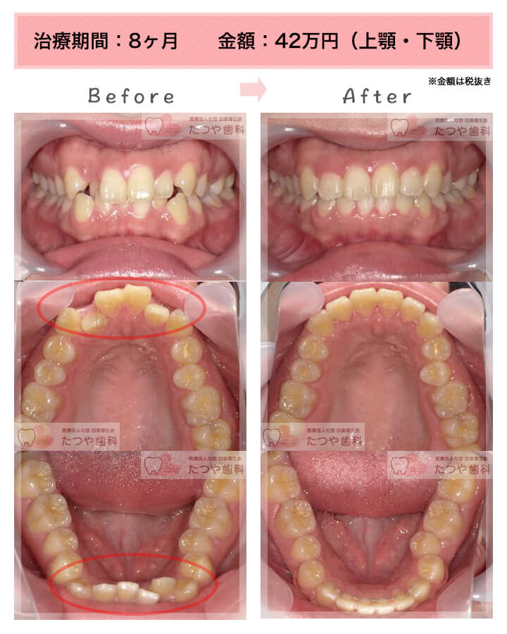 部分矯正の症例　上下の前歯