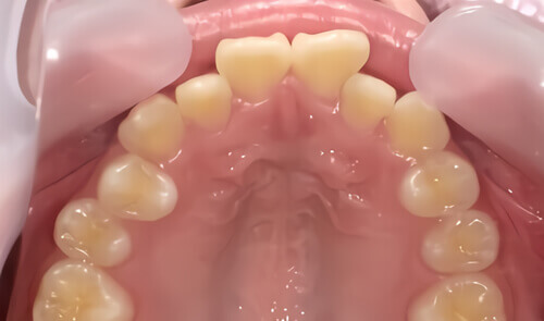 たつや歯科の部分矯正_タイプ別症例集_突き出た前歯