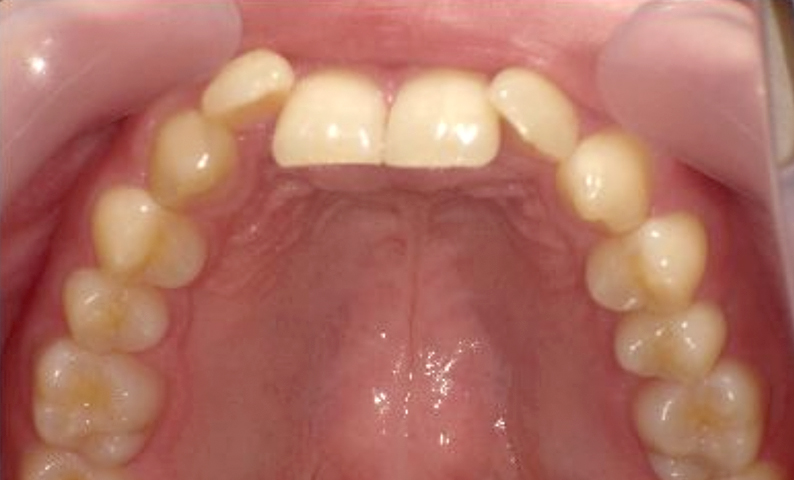 部分矯正 20代の症例写真