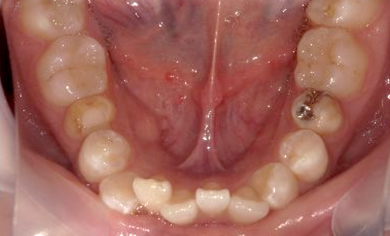 部分矯正 20代の症例写真