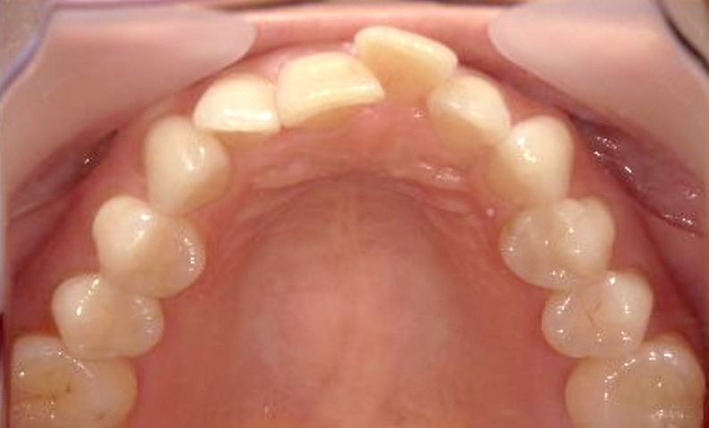 部分矯正 30代の症例写真