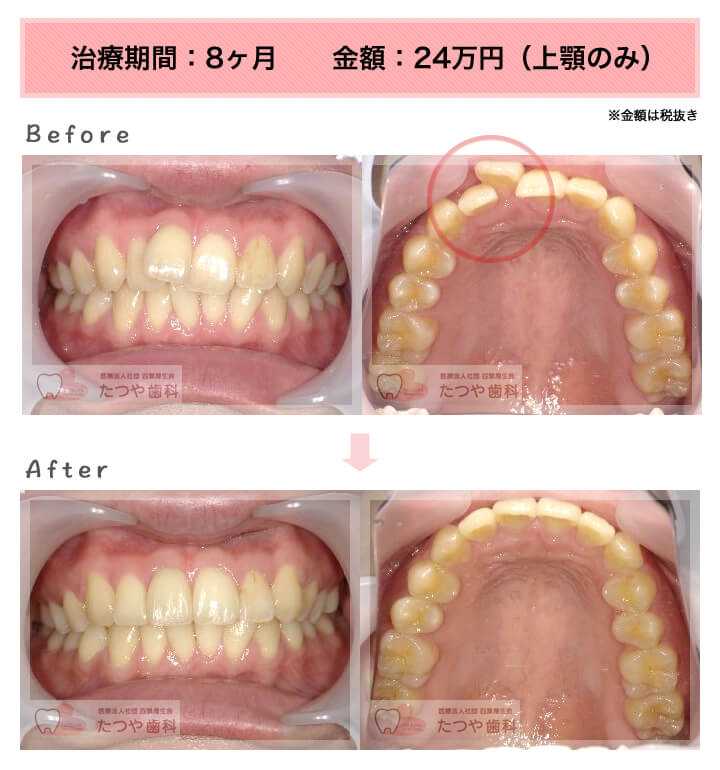 前歯1本だけ 症例紹介 東京の 安い前歯だけの部分矯正 部分矯正のたつや歯科