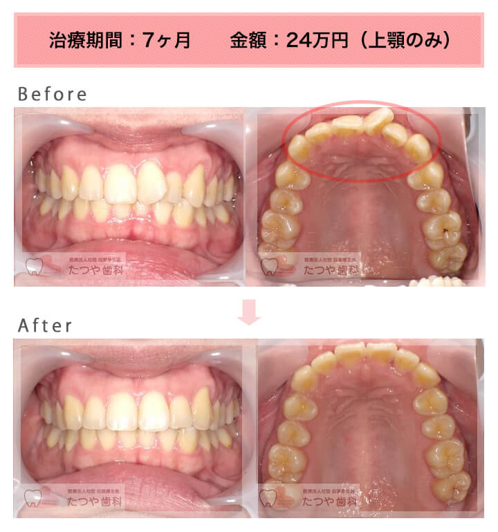 前歯1本だけ 症例紹介 東京の 安い前歯だけの部分矯正 部分矯正のたつや歯科