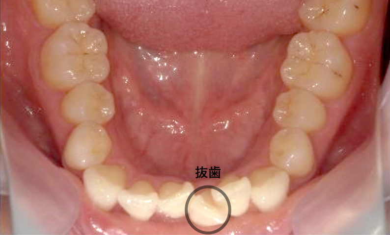 部分矯正 下の部分矯正の症例写真