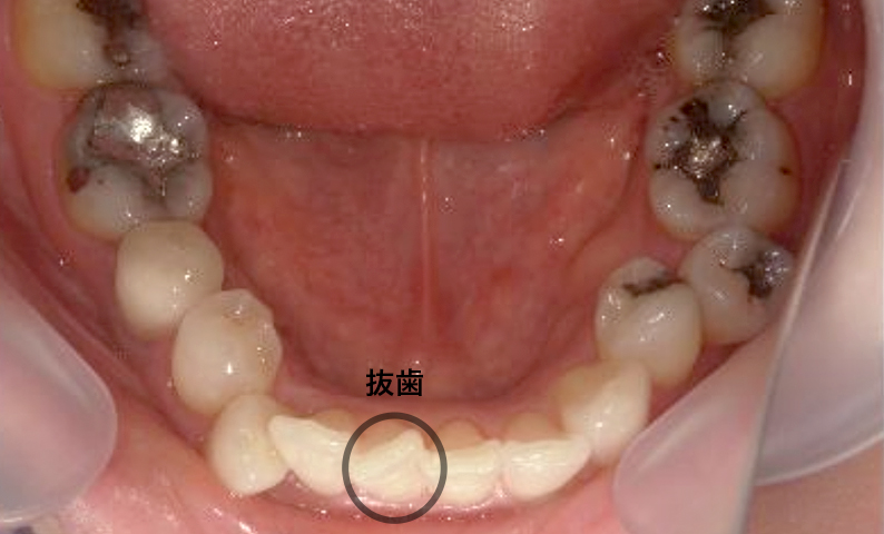 部分矯正 下の部分矯正の症例写真