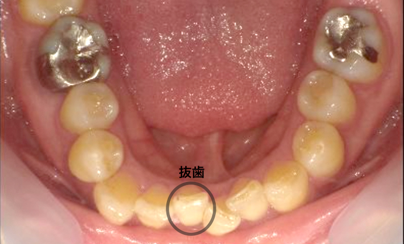 部分矯正 下の部分矯正の症例写真