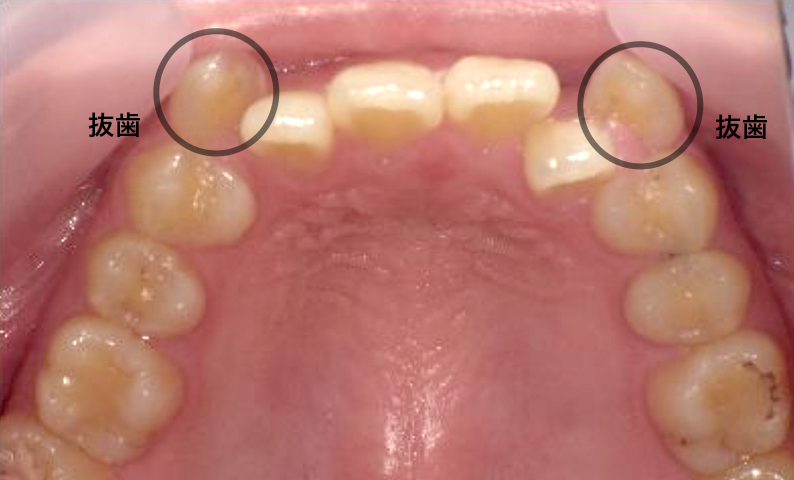 部分矯正 八重歯の症例写真
