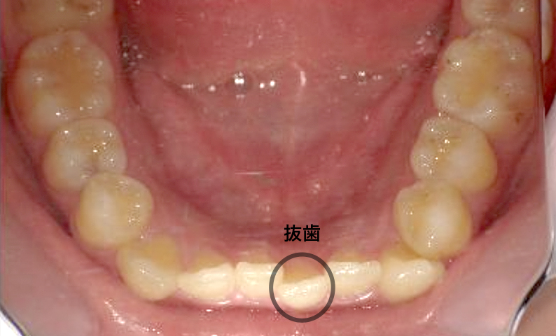 部分矯正 八重歯の症例写真