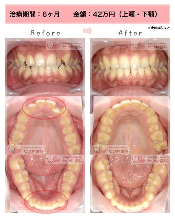 八重歯 症例紹介 東京の 安い前歯だけの部分矯正 部分矯正のたつや歯科