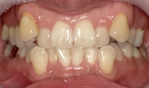 東京の 安い前歯だけの部分矯正 たつや歯科 治療実績豊富な矯正歯科